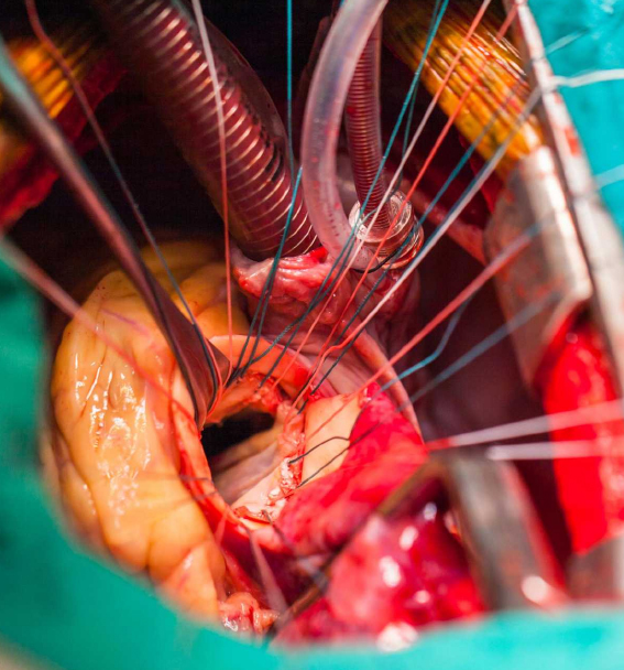 عمل جراحی قلب باز